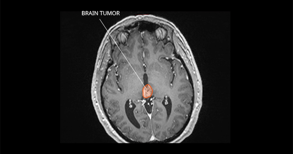 Pineal Region Tumors National Cancer Institute